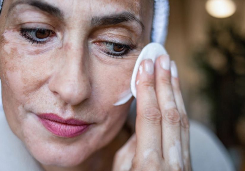 Addison’s Disease Effects on Skin: Symptoms and Treatment