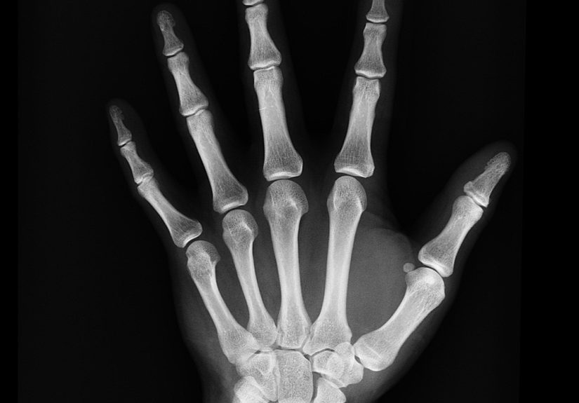 Do I Need Disability Insurance And How Much Does It Cost?