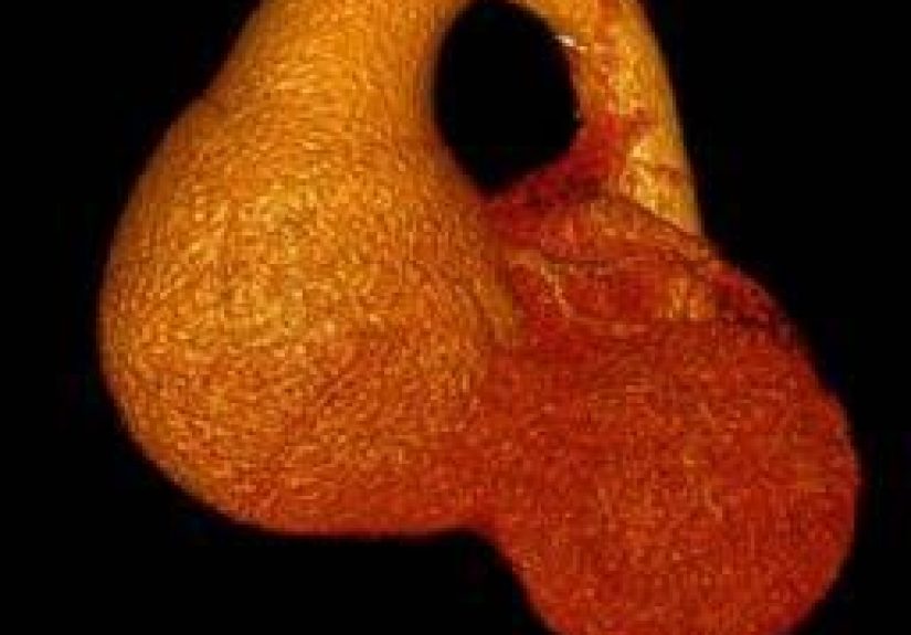 Ascending aortic aneurysm: Symptoms, causes, and types