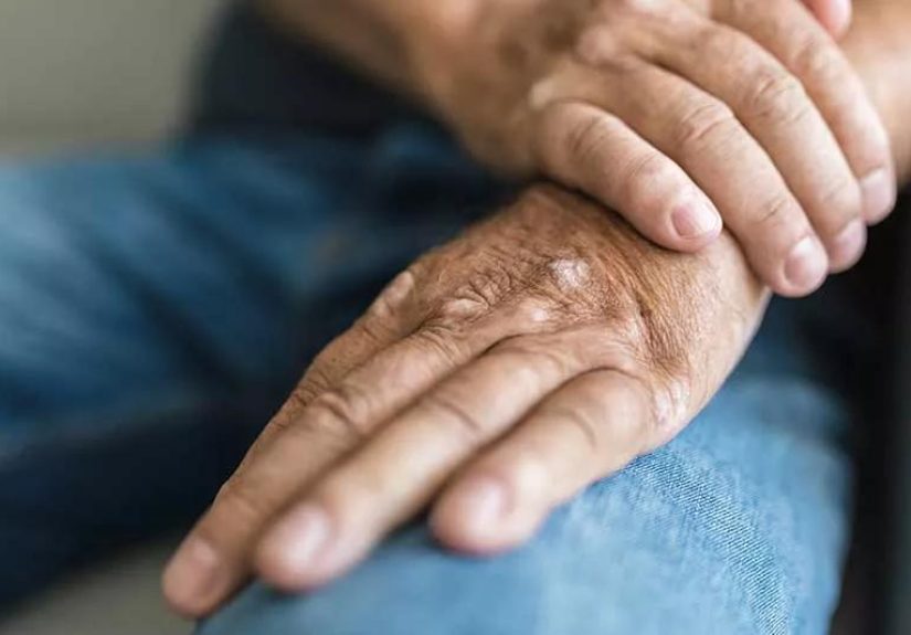How To Prevent Psoriatic Arthritis Flare-ups