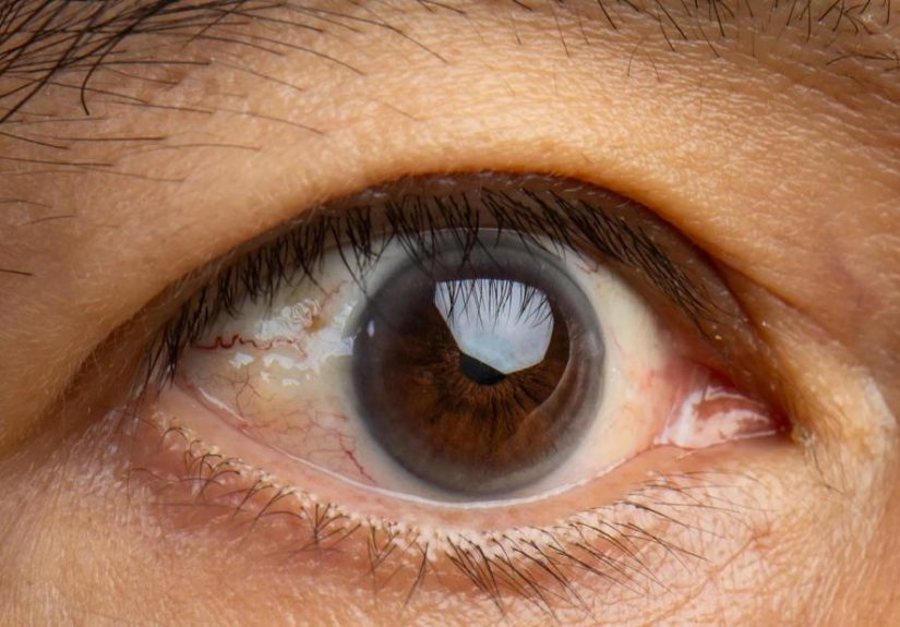 Pinguecula vs. Pterygium: What’s the Difference?