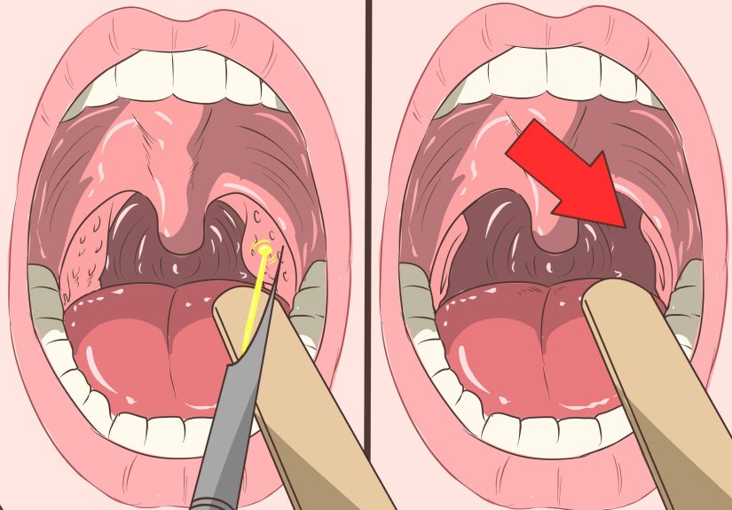 4 Ways to Remove Tonsil Stones (Tonsilloliths)