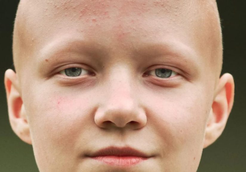 Alopecia Areata Eyebrow & Eyelash Loss