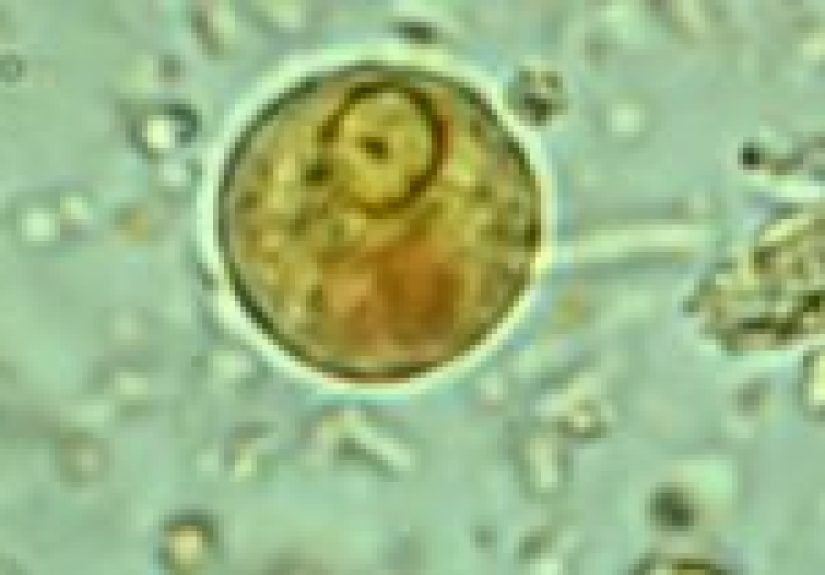 Amebiasis: Overview, Causes & Symptoms