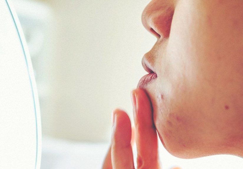 Are Boils Contagious? Prevention and Treatment