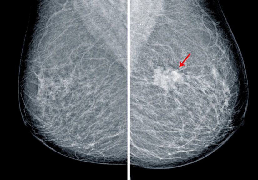 Calcification in Breast: Types, Causes and Treatment