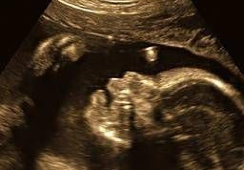 Ectopia cordis: Causes, complications, and outlook