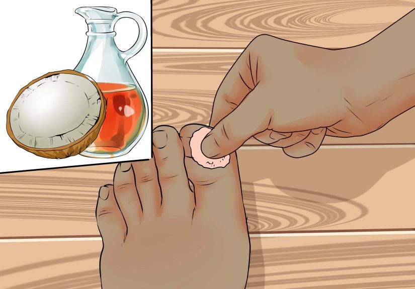 How to Avoid Ingrown Toenails: 10 Steps