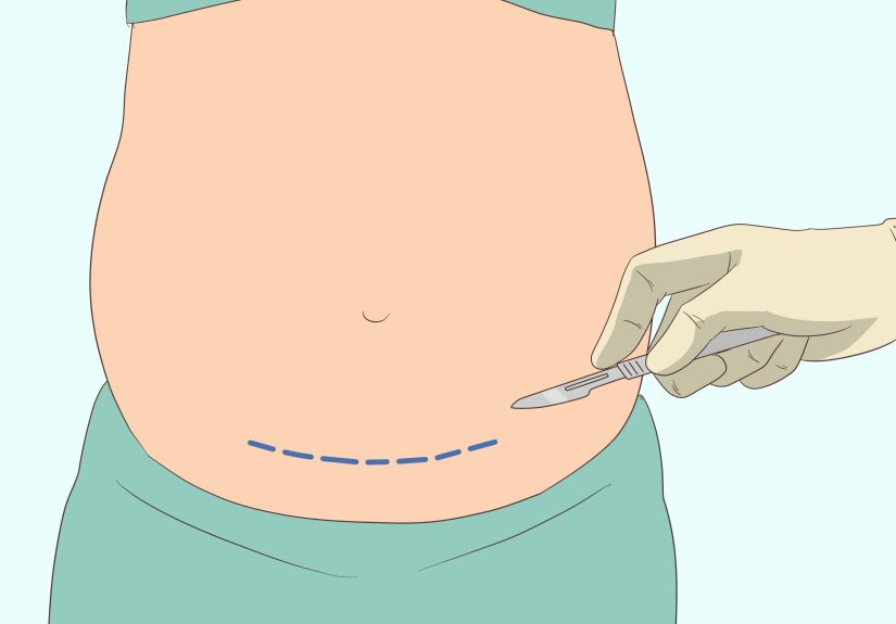 How to Detect Pregnancy if You Have PCOS & When to Test