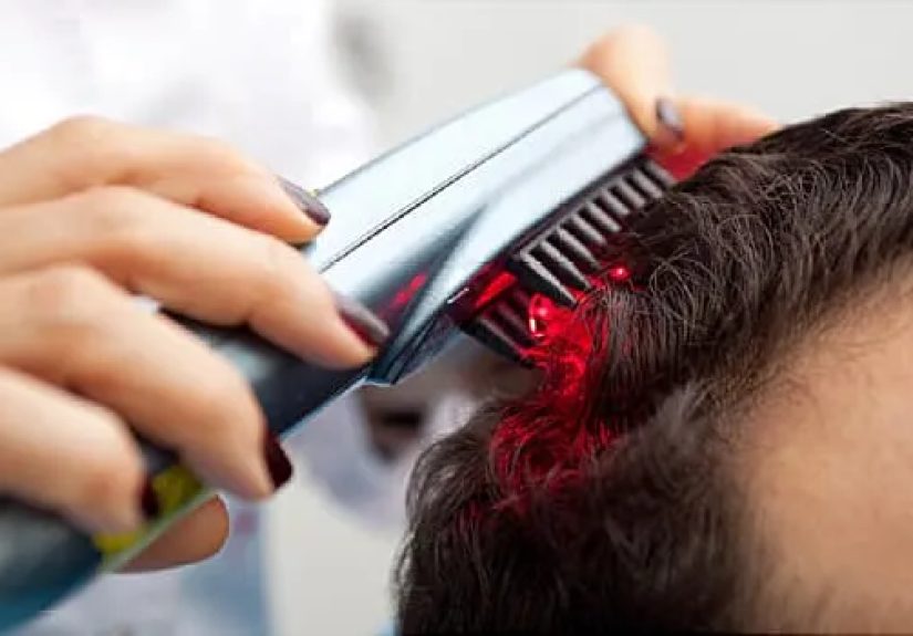 Nonsurgical Hair Loss Treatments