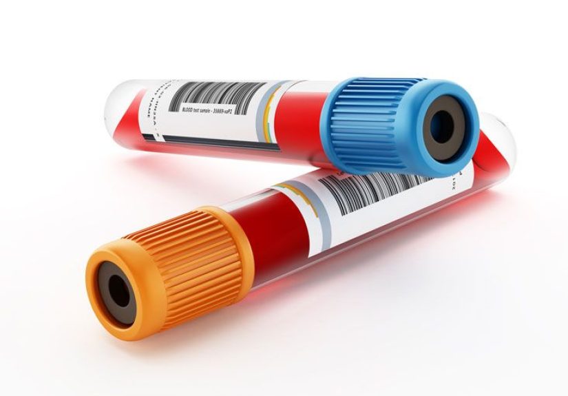 Partial Thromboplastin Time (PTT) Test: Purpose and Procedure