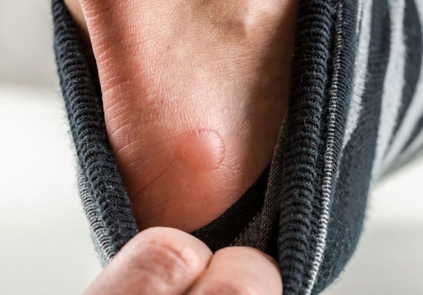 Vesicles: Causes, Symptoms, and Diagnosis