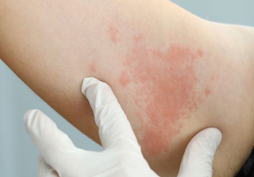 Why Do Hives Occur with HIV?