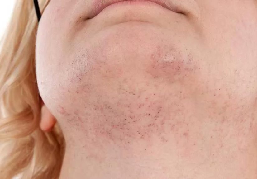 Why Women Get Chin Hair and Treatment Options