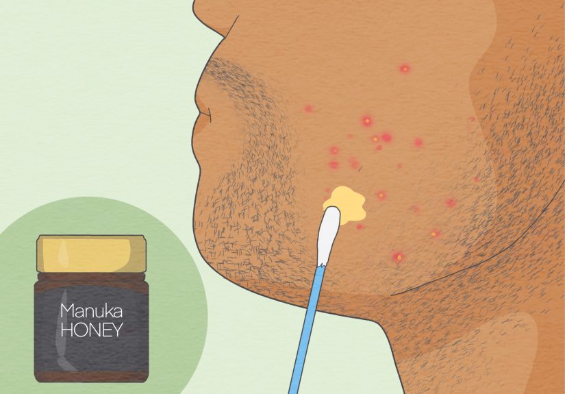 3 Ways to Treat Infected Ingrown Hair