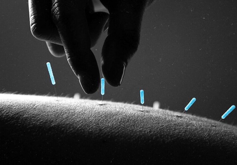 Acupuncture Could Help Reduce Type 2 Diabetes Risk