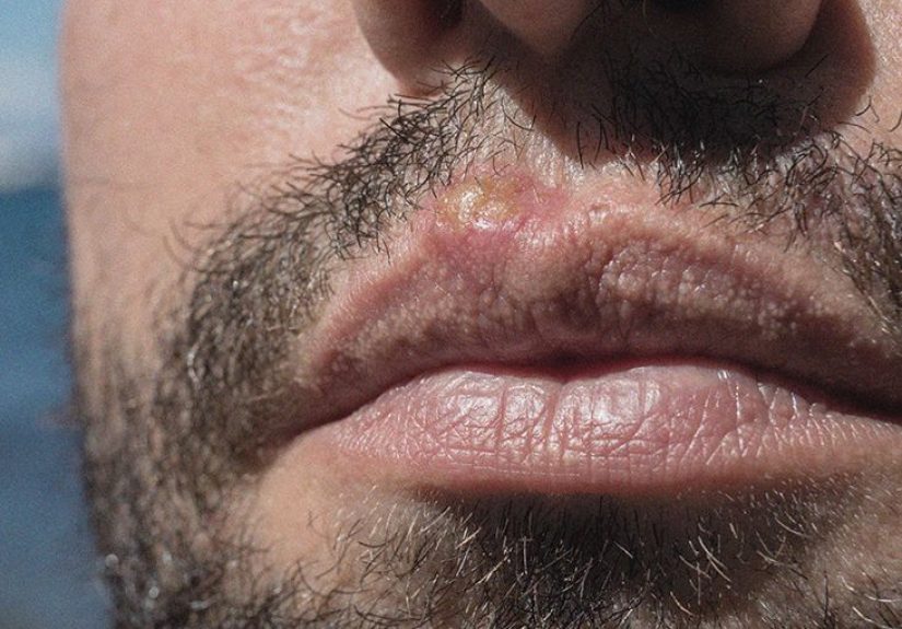 Blister on Lip: What Are the Different Types and How Are They Treated?
