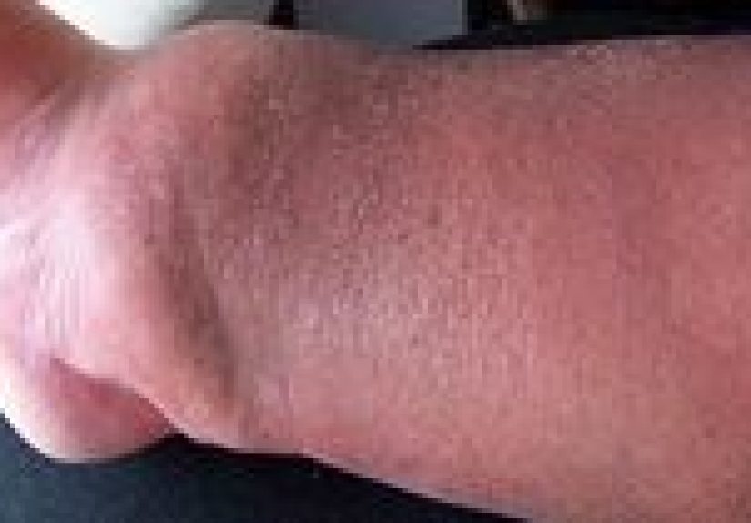 Bone Infection (Osteomyelitis): Symptoms and Treatments