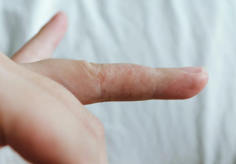 Eczema Blisters: How to Help Prevent and Treat Them