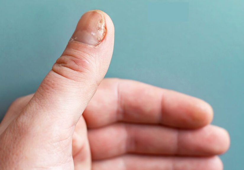 Nail Psoriasis Severity Index: What It Is and How Doctors Use It