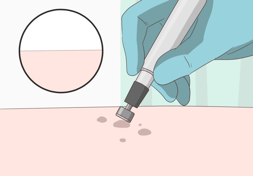 3 Ways to Get Rid of Back Acne Scars
