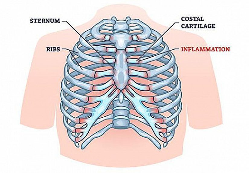 Chest Pain That Mimics a Heart Attack - Harvard Health