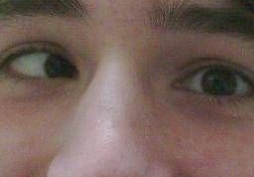 Esotropia: Types, Symptoms, and Treatment