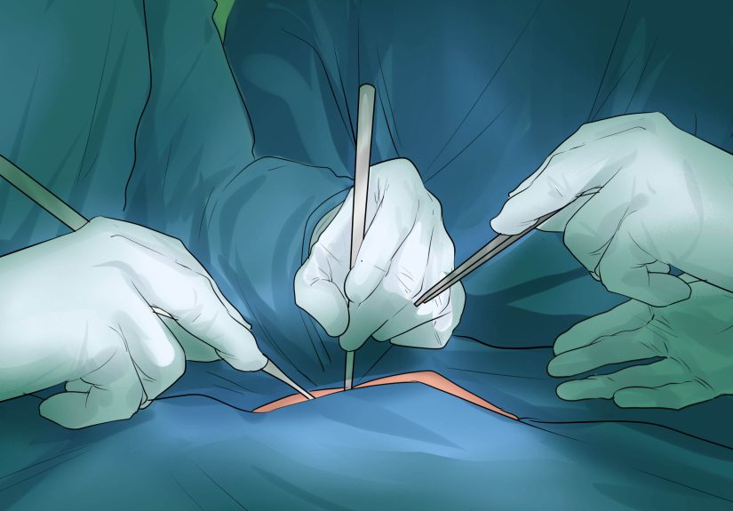 How to Tell if You Have Internal Hemorrhoids: Top Symptoms