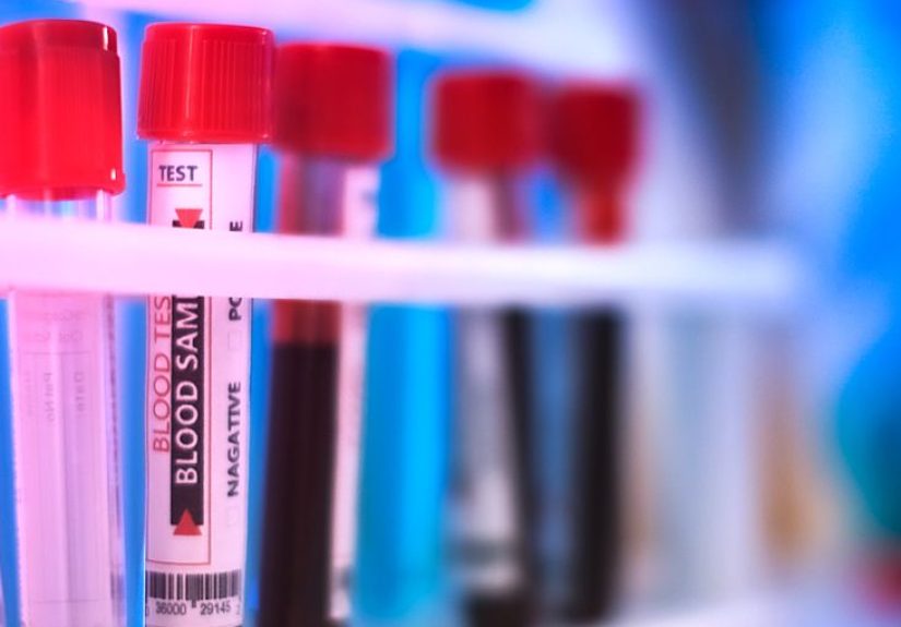 Lupus anticoagulant: Causes, symptoms, and tests