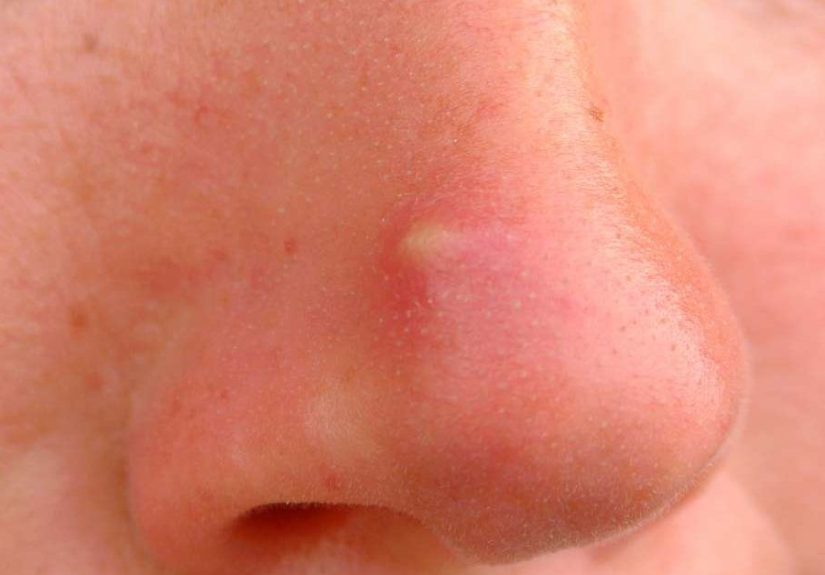 Nose Acne: Causes, Treatment, and Remedies