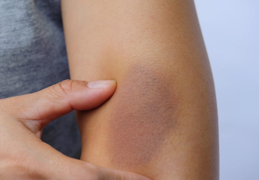 Why Do Your Arms Bruise After Working Out?
